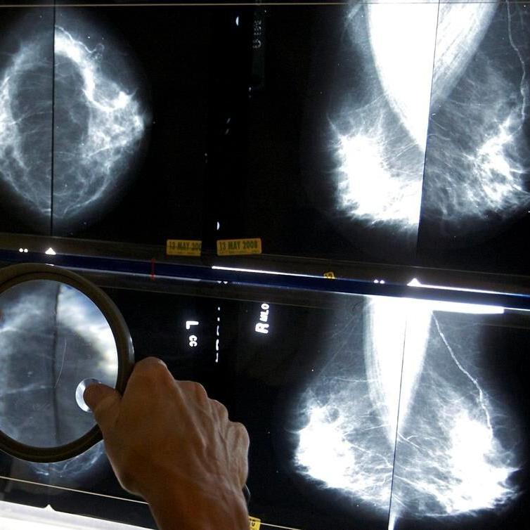 Breast cancer screening should start at age 40, ºÚÁϳԹÏÍø Cancer Society says